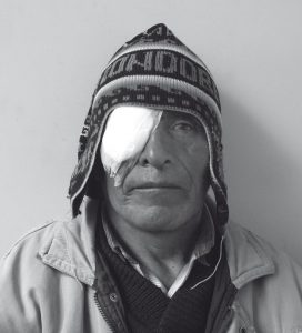 Pacient després d’una operació ocular 