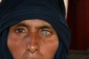 Una mujer con cataratas en el ojo derecho 