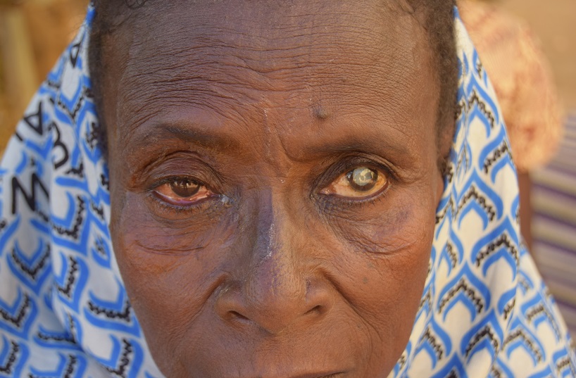 Woman with cataract