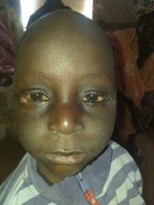 Infant amb tracoma