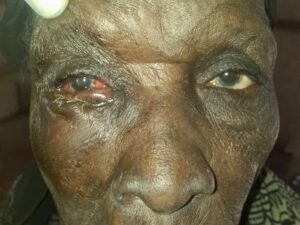 A person with trachoma
