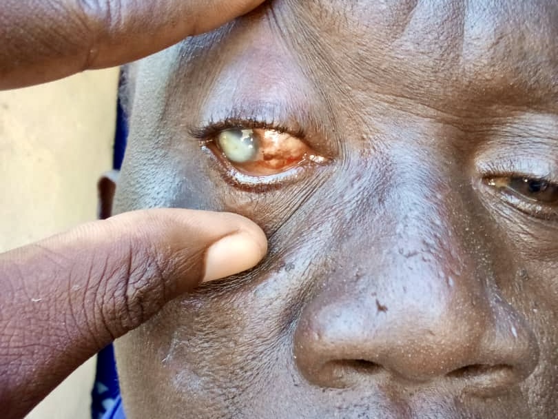 Fotografía de un ojo del paciente para hacer teleconsulta