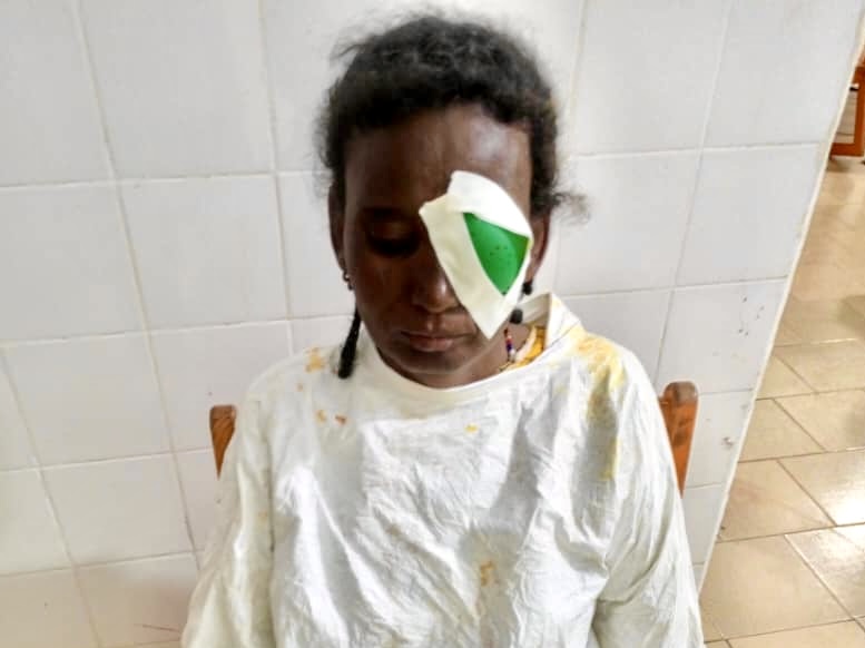 Malian girl treated for cataracts with a covered eye